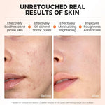 Before_After_Skin_Results_Acne_Pore_Minimizing