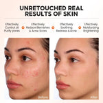 Before_after_comparison_of_acne_prone_skin_using_serum